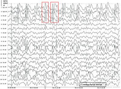 Case Report: Christianson Syndrome Caused by SLC9A6 Mutation: From Case to Genotype-Phenotype Analysis